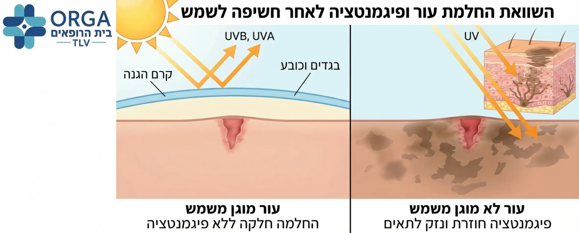 תמונה המשווה בין עור מוגן משמש שמחלים בצורה חלקה, לעומת עור שנחשף לשמש ופיתח פיגמנטציה חוזרת, עם הסבר ויזואלי על חדירת קרני ה-UV
