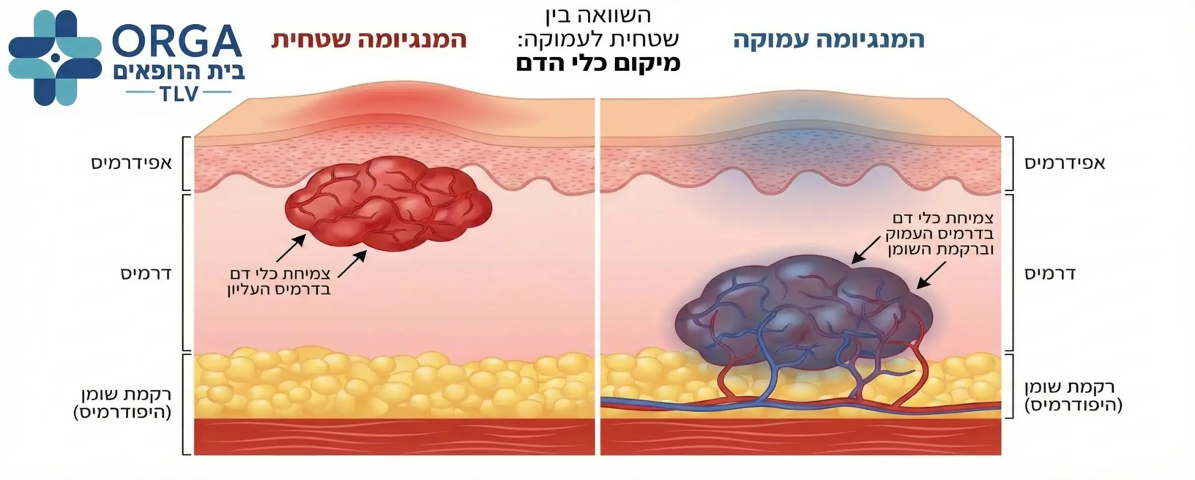 אינפוגרפיקה המציגה חתך רוחב של העור עם המנגיומה שטחית לעומת המנגיומה עמוקה, המדגישה את ההבדל במיקום כלי הדם