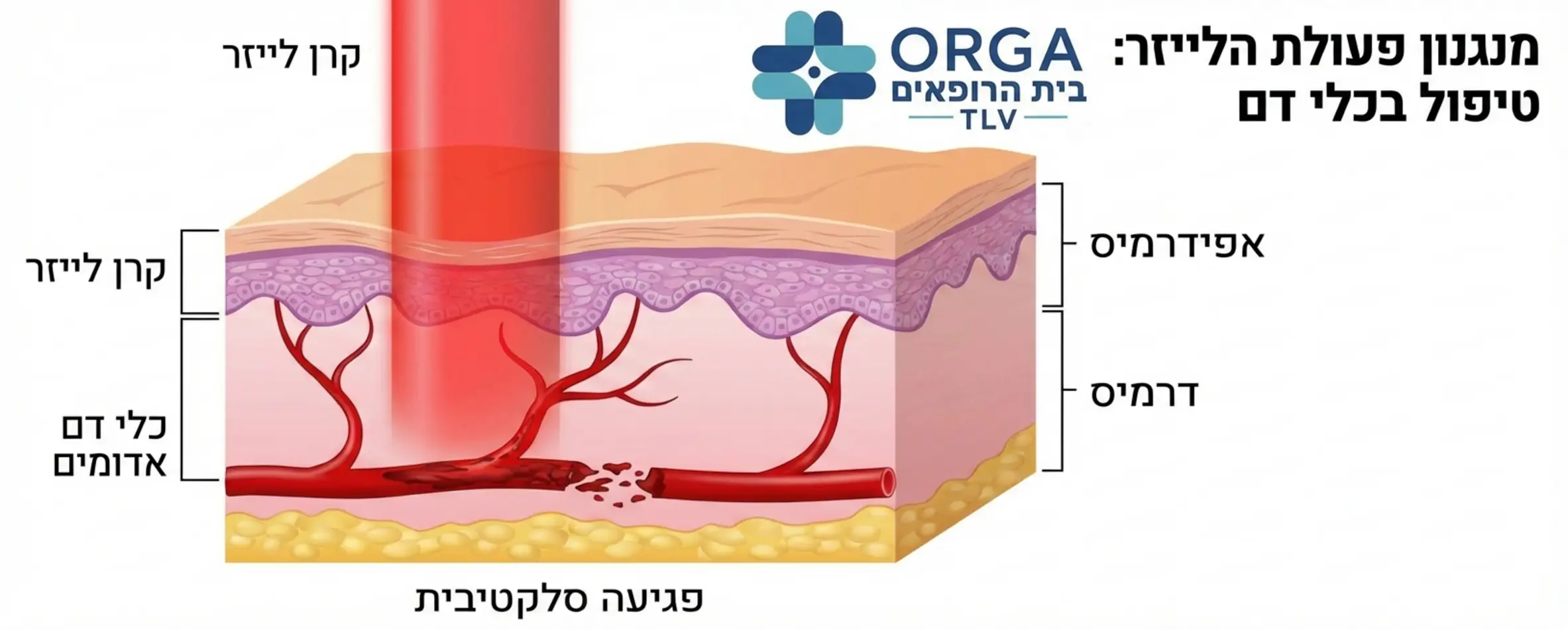 תמונה הממחישה את מנגנון הפעולה של הלייזר: קרן אור חודרת את האפידרמיס ופוגעת רק בכלי הדם האדומים מתחת לעור