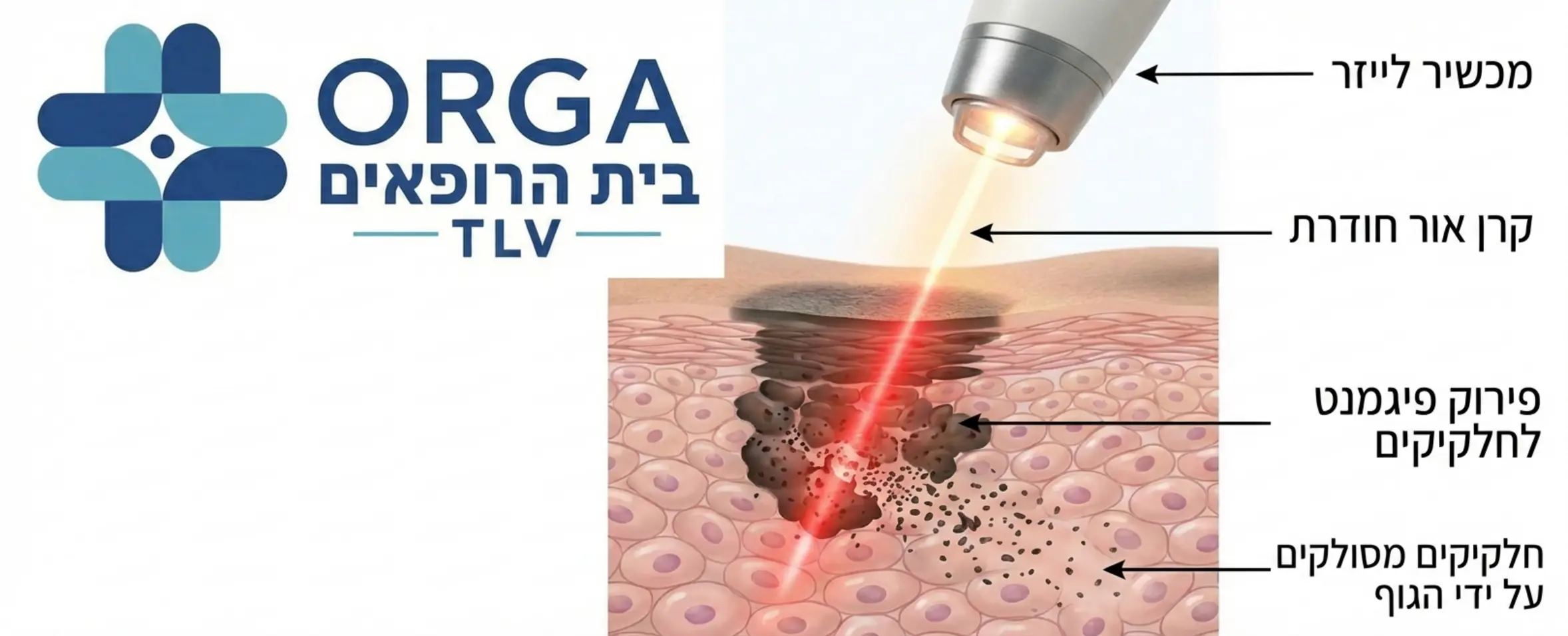 תמונה הממחישה את תהליך הטיפול בלייזר: מכשיר ידית לייזר מעל העור, קרן אור חודרת, ופירוק של הפיגמנט לחלקיקים זעירים מתחת לפני השטח