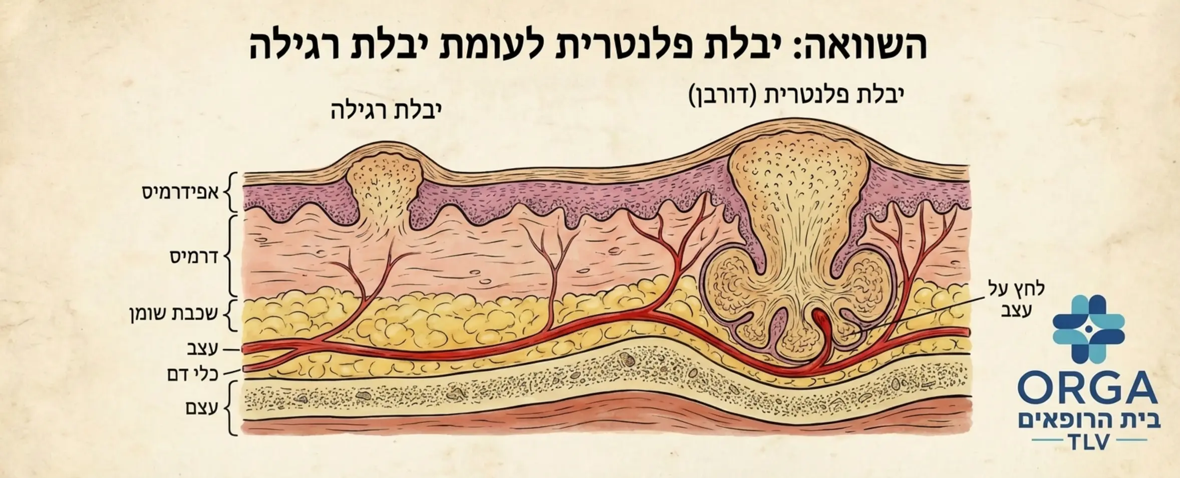 איור אנטומי של כף רגל בחתך צד, המראה כיצד יבלת פלנטרית צומחת עמוק לתוך שכבת הדרמיס ולוחצת על עצבים, בניגוד ליבלת רגילה שצומחת החוצה
