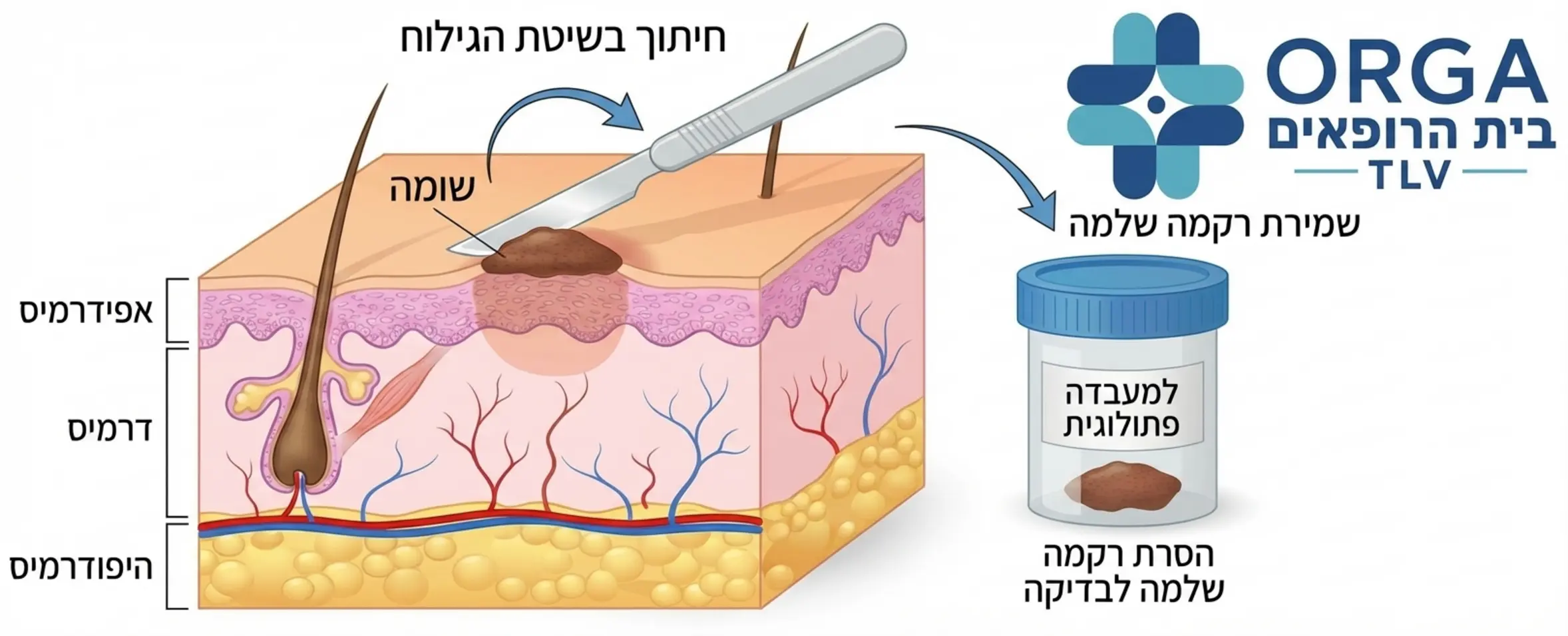 אינפוגרפיקה רפואית המציגה את שכבות העור בחתך רוחב וממחישה את פעולת חיתוך נקודת החן בשיטת הגילוח באמצעות להב עדין, תוך הדגשה של שמירת הרקמה השלמה לצורך שליחה למעבדה פתולוגית