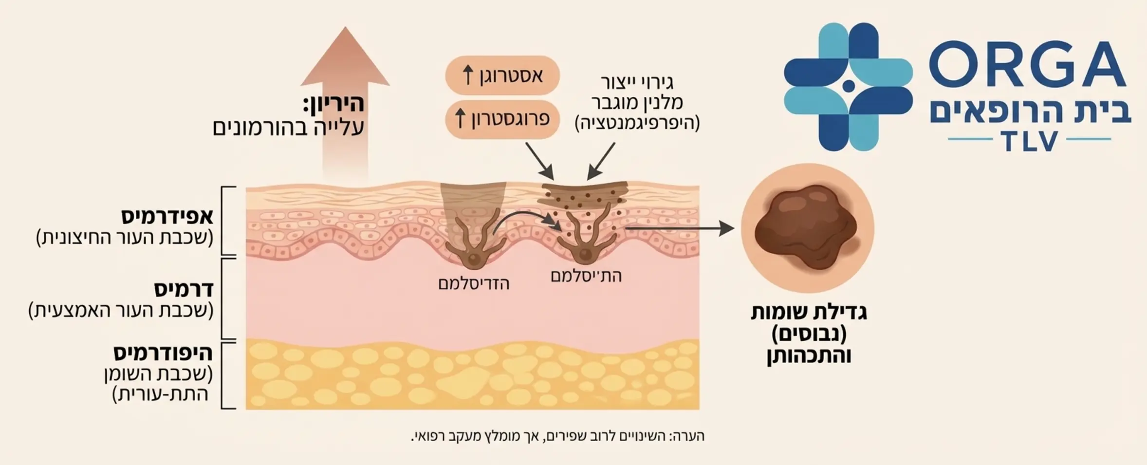אינפוגרפיקה המציגה את שכבות העור ואת ההשפעה של עלייה בהורמוני האסטרוגן והפרוגסטרון על ייצור המלנין בתקופת ההיריון וגדילת שומות