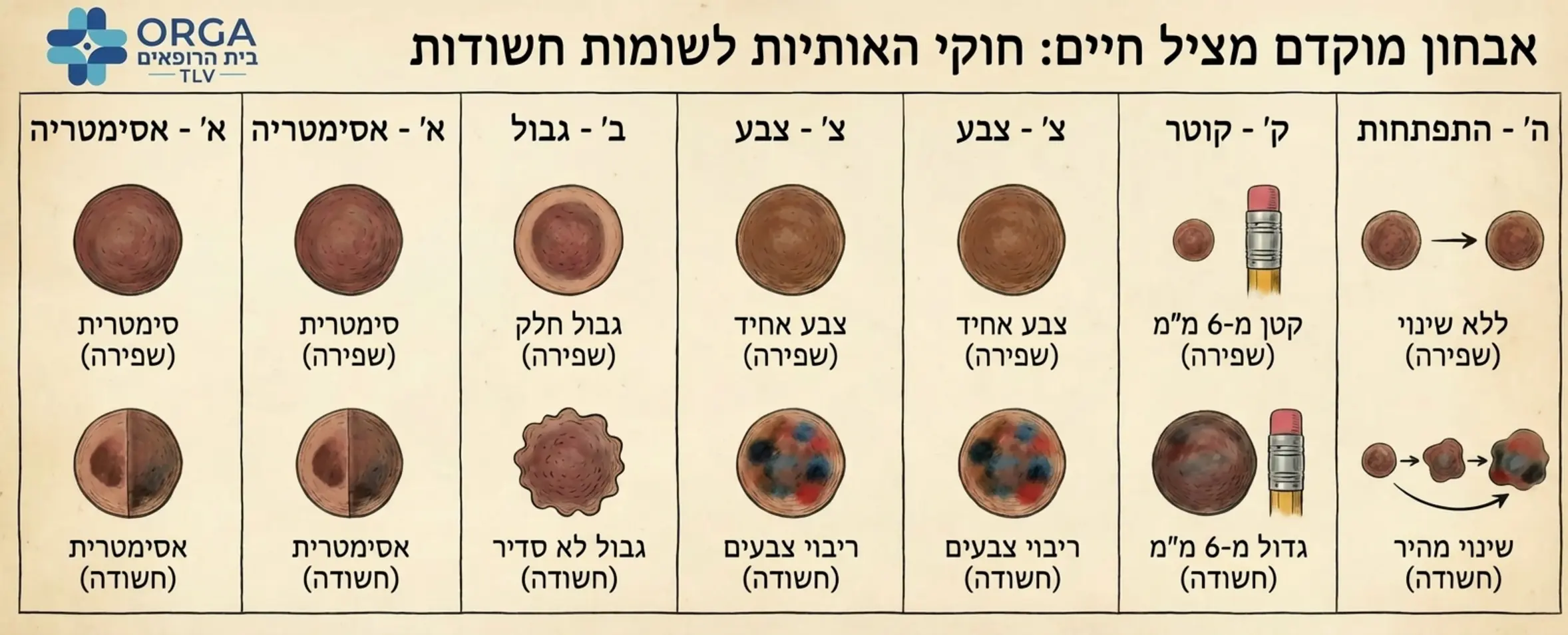 איור רפואי המסביר את חוקי האותיות לאבחון שומות חשודות כולל דוגמאות ויזואליות המדגימות אסימטריה גבולות צבע קוטר והתפתחות מהירה