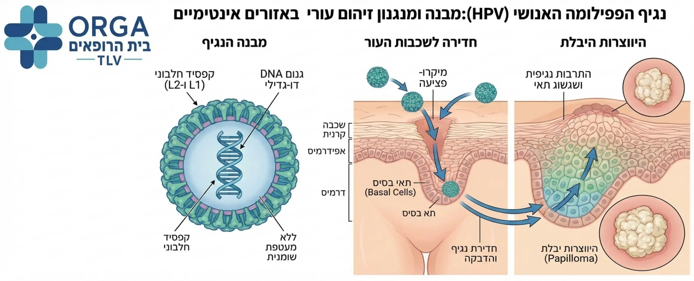 אינפוגרפיקה מדעית המציגה את המבנה של וירוס הפפילומה האנושי וכיצד הוא חודר לשכבות העור העליונות באזורים האינטימיים ומייצר את היבלת