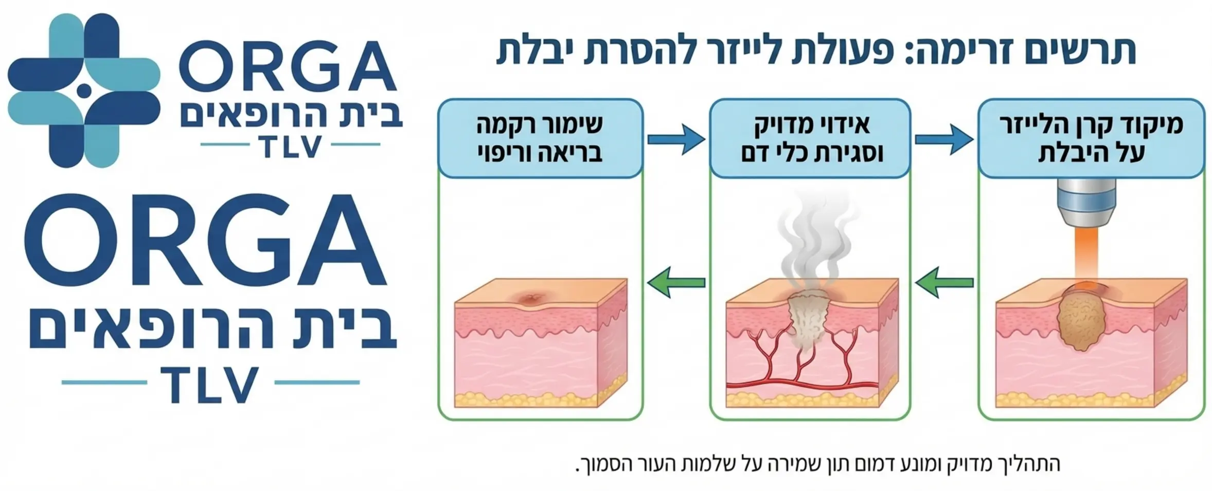 תרשים זרימה המדגים את פעולת קרן הלייזר הממוקדת המאדה את היבלת העורית מבלי לפגוע ברקמה הבריאה שסביבה תוך סגירת כלי הדם