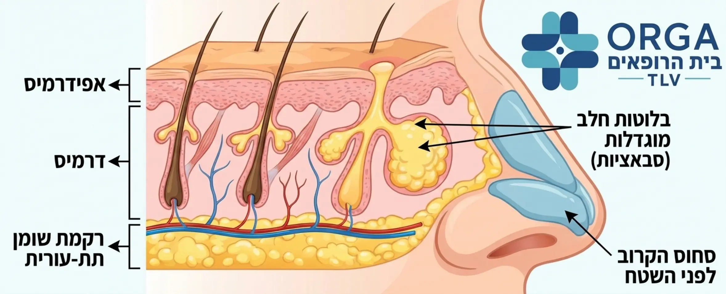 אינפוגרפיקה רפואית המציגה את שכבות העור באזור האף כולל בלוטות החלב המוגדלות והסחוס הקרוב לפני השטח
