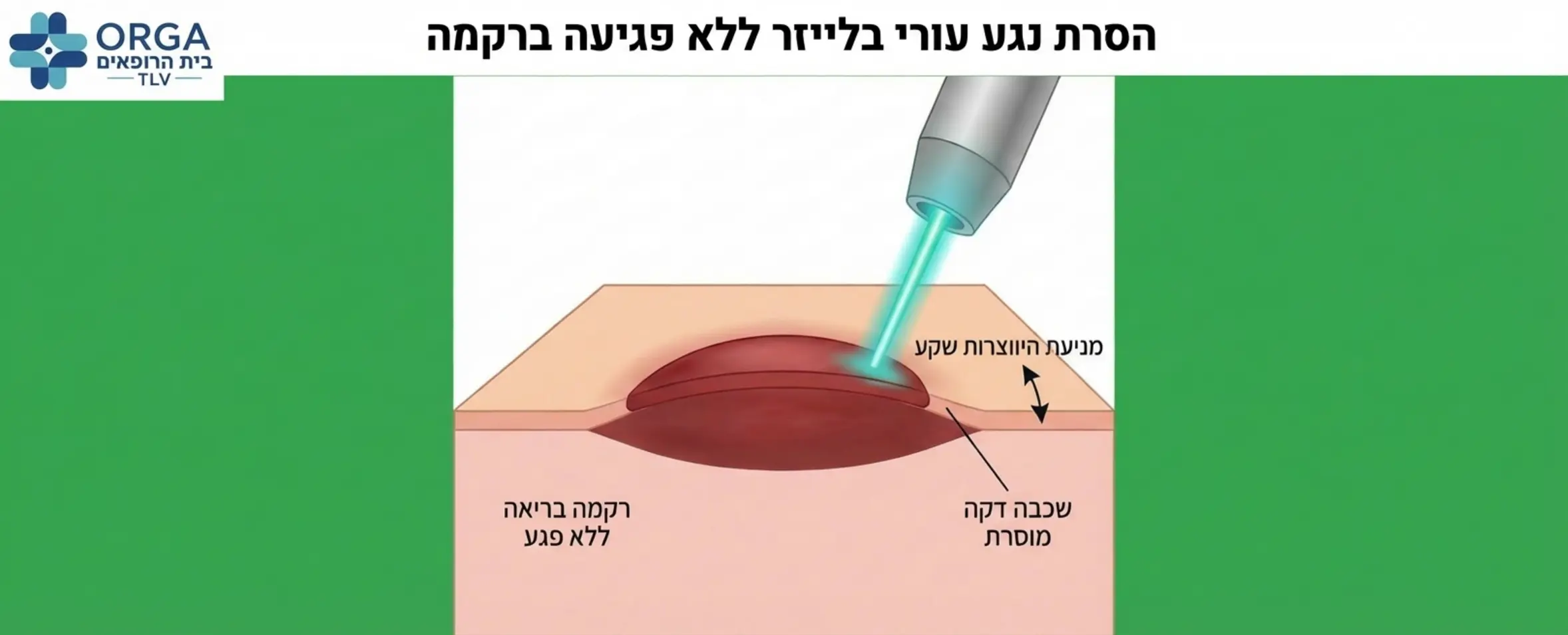 המחשה חזותית של קרן לייזר המסירה שכבה דקה של נגע עורי מבלי לפגוע ברקמה הבריאה מסביב למניעת היווצרות שקע בעור