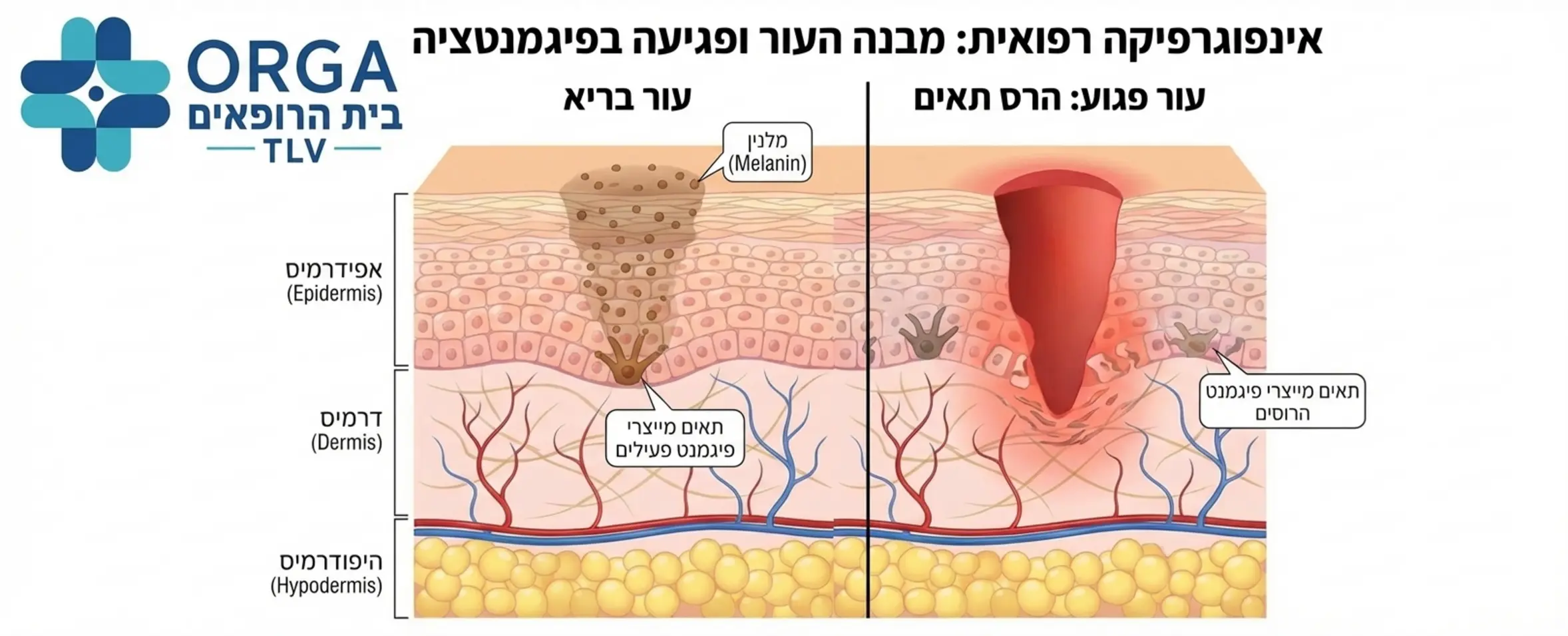 אינפוגרפיקה רפואית המציגה את שכבות העור וממחישה כיצד פגיעה בשכבה העמוקה גורמת להרס של תאים מייצרי פיגמנט לעומת עור בריא ובו תאים פעילים