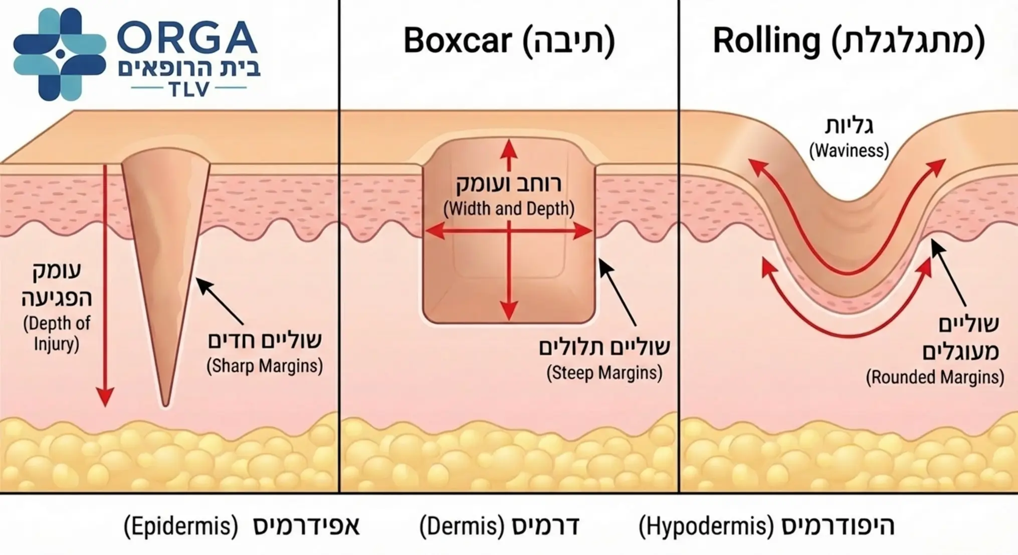 אינפוגרפיקה מקצועית המציגה חתך רוחב של העור עם שלושת סוגי צלקות האקנה השקועות: Ice pick, Boxcar, Rolling, תוך הדגשת עומק הפגיעה ברקמה ושולי הצלקת בכל אחד מהסוגים