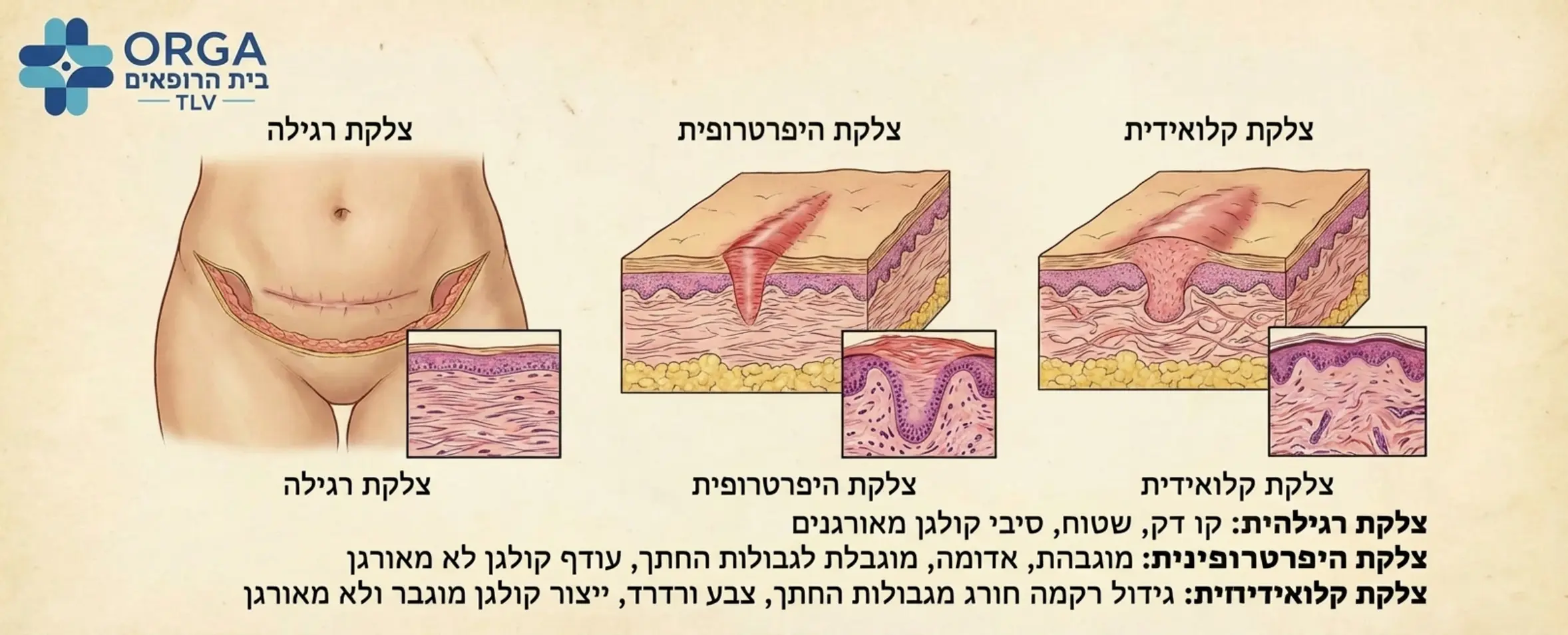 איור אנטומי רפואי מדויק המסביר את ההבדל הוויזואלי והמבני בין צלקת רגילה צלקת היפרטרופית וצלקת קלואידית באזור שיפולי הבטן לאחר ניתוח קיסרי