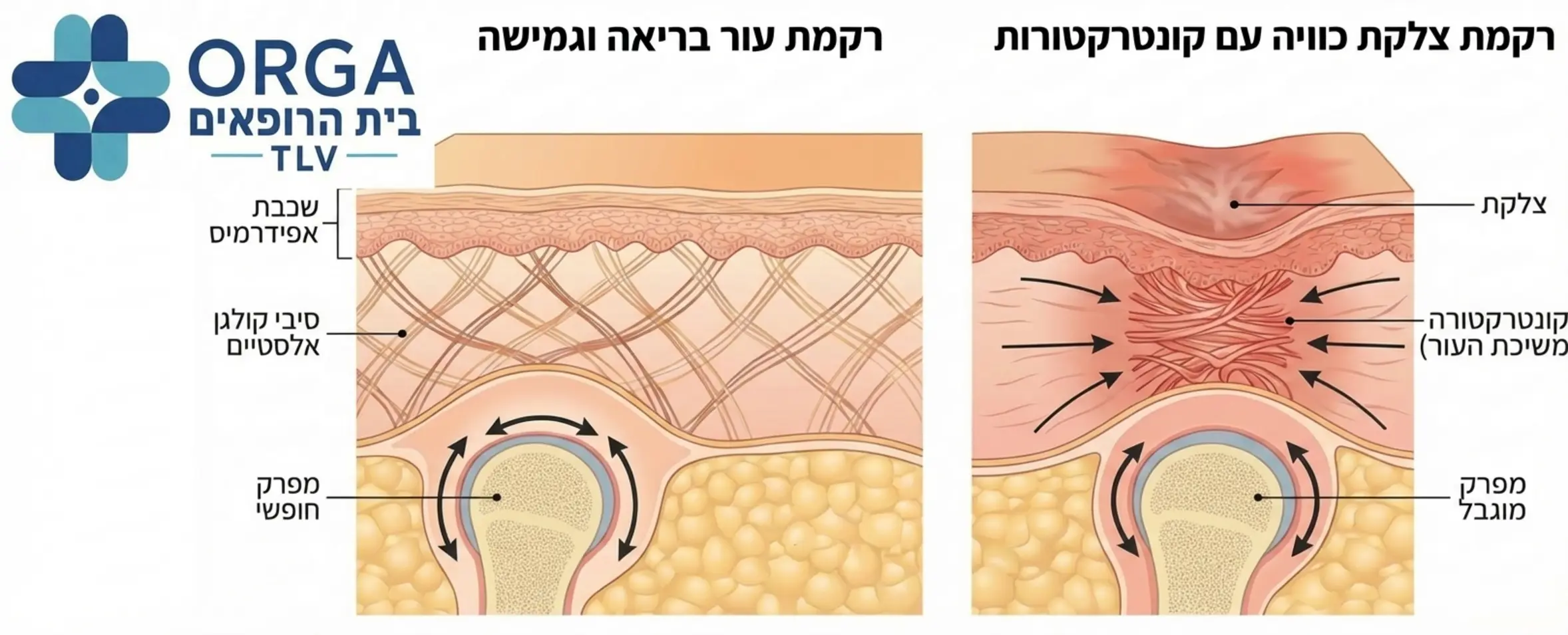 אינפוגרפיקה המדגימה את ההבדל בין רקמת עור בריאה וגמישה לבין רקמת עור מצולקת לאחר כוויה הכוללת היווצרות של קונטרקטורות המושכות את העור אל עבר מרכז הצלקת ומגבילות את המפרק