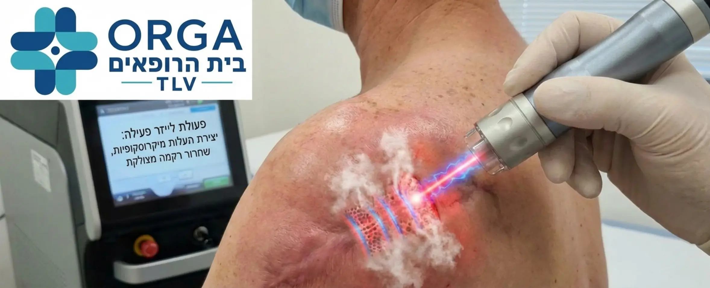 צילום תקריב של מכשיר לייזר רפואי מתקדם בפעולה על אזור כתף מצולק כאשר אלומת האור מדגימה בצורה גרפית את יצירת התעלות המיקרוסקופיות בעור ושחרור הרקמה