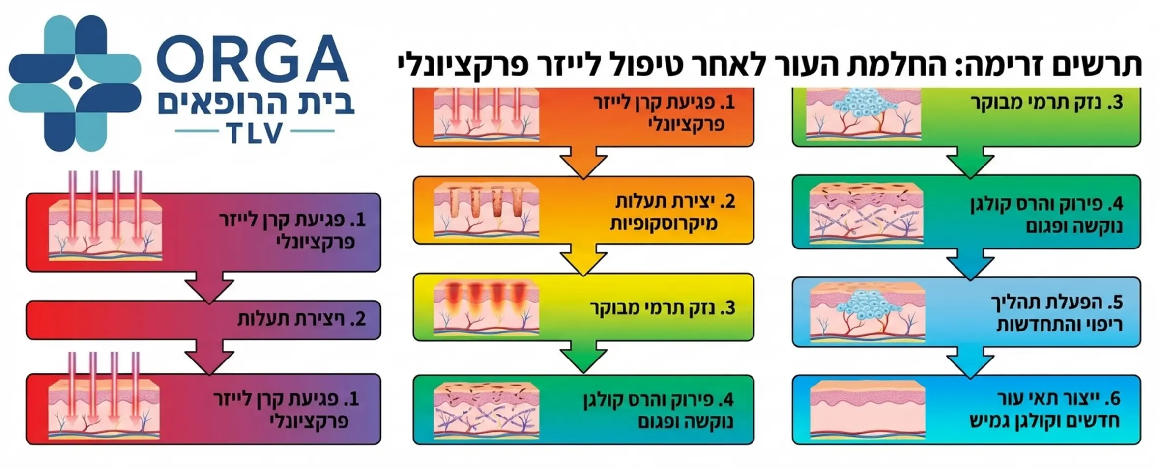 תרשים זרימה אנכי המציג את שלבי ההחלמה של העור לאחר טיפול בלייזר פרקציונלי החל משלב פגיעת קרן האור ויצירת התעלות דרך הריסה של קולגן נוקשה ועד לייצור תאי עור חדשים וגמישים