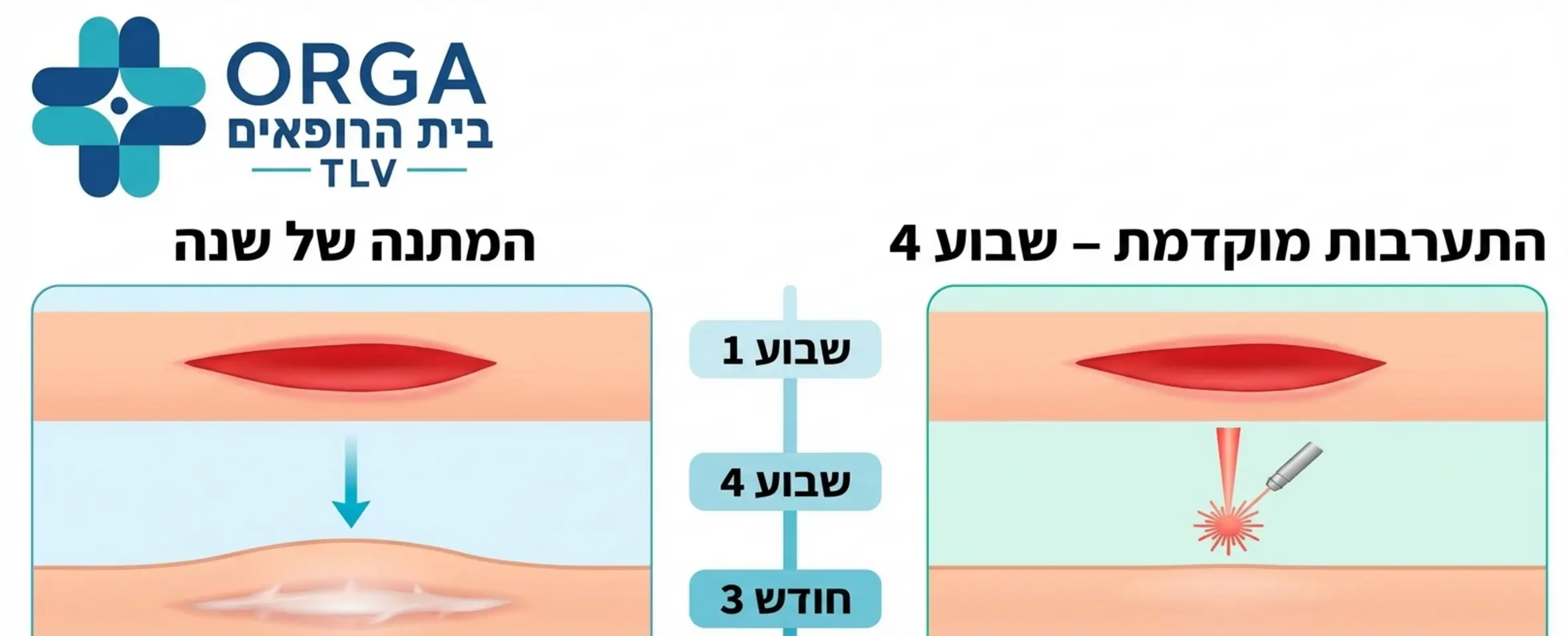 אינפוגרפיקה מקצועית המציגה את ציר הזמן של היווצרות צלקת. בצד אחד מראה מה קורה כשממתינים שנה ומקבלים צלקת בולטת ולבנה, ובצד השני מראה התערבות מוקדמת של טיפול לייזר בשבוע הרביעי המובילה להחלמה חלקה וטבעית של העור