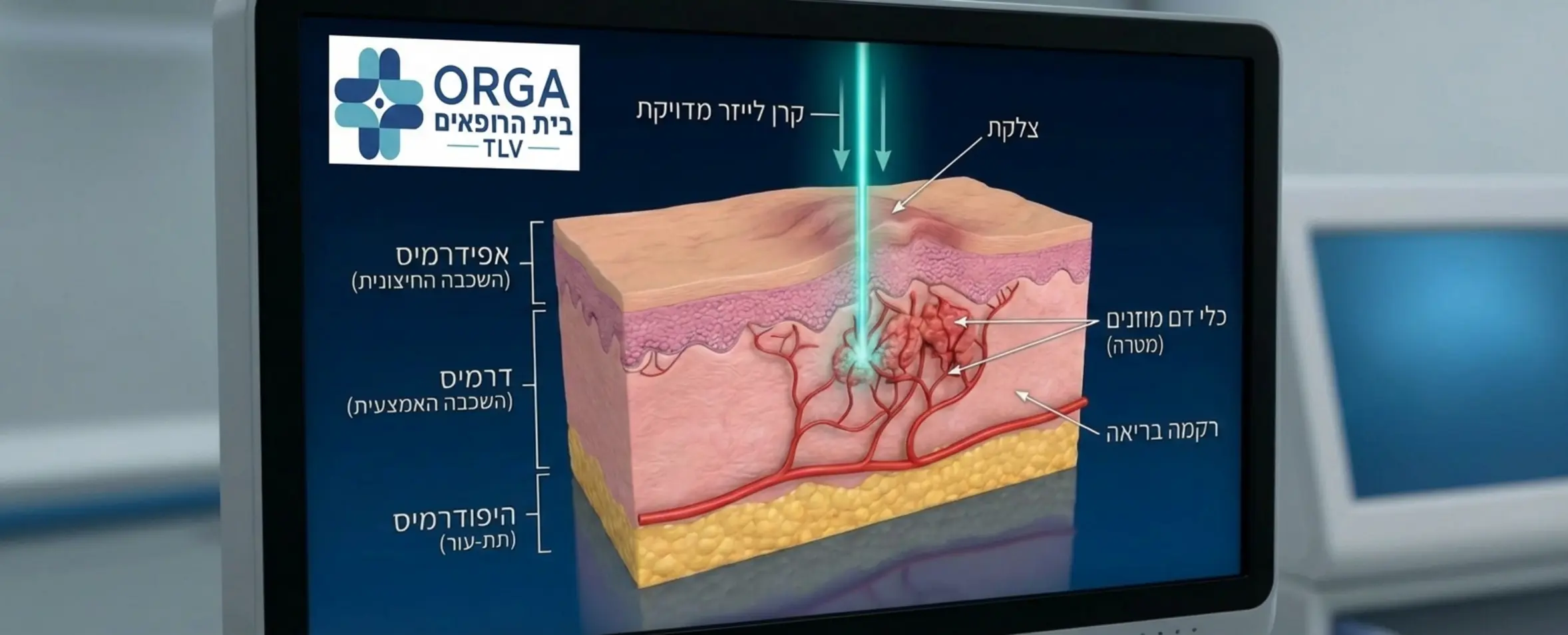 תרשים רפואי תלת ממדי המראה חתך רוחב של העור. בתמונה רואים כיצד קרן לייזר חודרת את שכבת האפידרמיס ופוגעת בדיוק רב בכלי הדם האדומים שמזינים את הצלקת, מבלי לפגוע ברקמה הבריאה מסביב