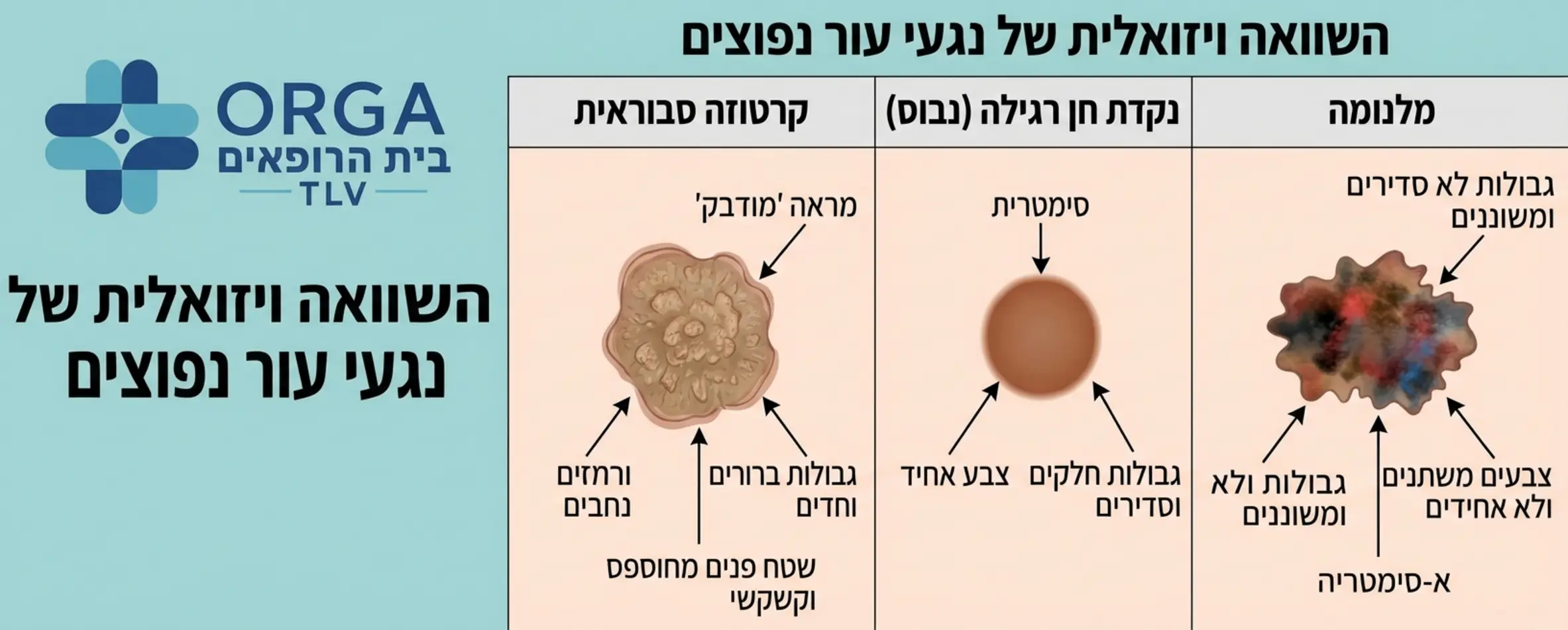 אינפוגרפיקה המציגה השוואה ויזואלית ברורה בין קרטוזה סבוראית (מראה מודבק, גבולות ברורים, מחוספס) לבין נקודת חן רגילה (סימטרית, חלקה) ולבין מלנומה (גבולות לא סדירים, צבעים משתנים). האיור כולל חיצים המצביעים על המאפיינים הייחודיים של כל נגע