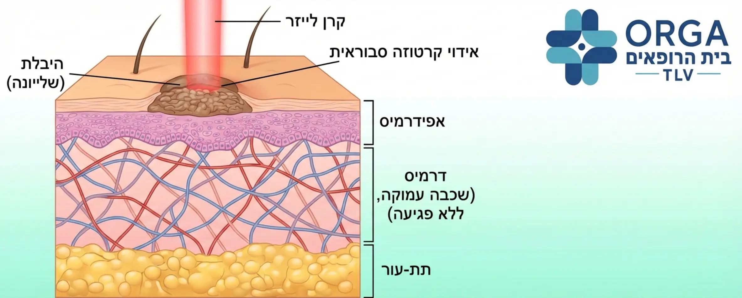 אילוסטרציה של חתך רוחב בעור המדגימה את פעולת הלייזר על קרטוזה סבוראית. האיור מראה כיצד קרן הלייזר מאדה רק את השכבה העליונה הבולטת (