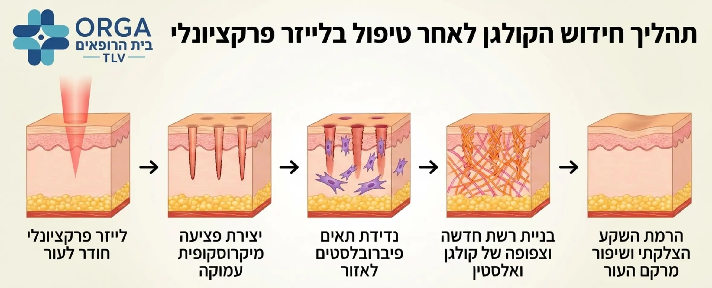 תרשים זרימה המדגים את תהליך חידוש הקולגן בעור לאחר טיפול בלייזר פרקציונלי. התרשים מראה את קרן הלייזר החודרת לעור, את יצירת הפציעה המיקרוסקופית העמוקה, ולאחר מכן את נדידת התאים הפיברובלסטים לאזור ובניית רשת חדשה וצפופה של סיבי קולגן ואלסטין המרימים את השקע הצלקתי