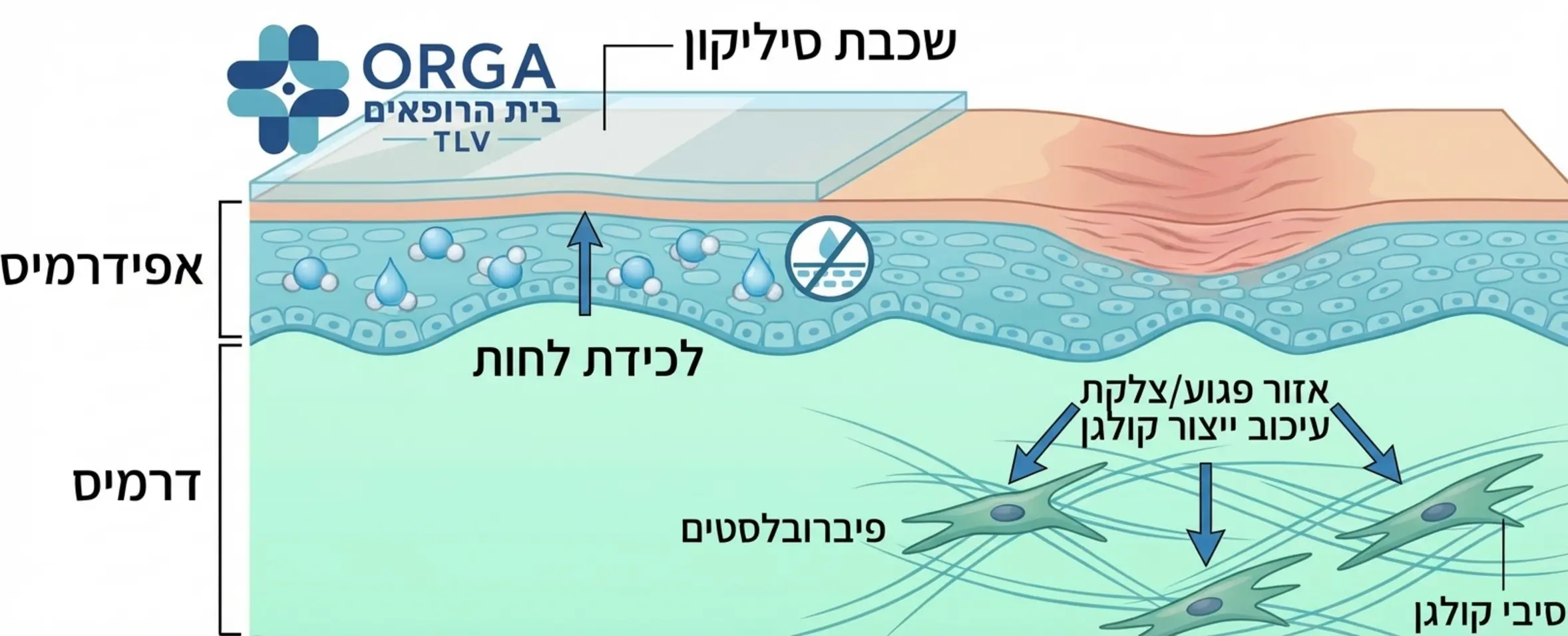 אינפוגרפיקה רפואית המציגה חתך רוחב של העור ומדגימה כיצד שכבת הסיליקון לוכדת את הלחות בשכבת האפידרמיס ומונעת במקביל ייצור מוגבר של סיבי קולגן על ידי תאי הפיברובלסט באזור הפגוע