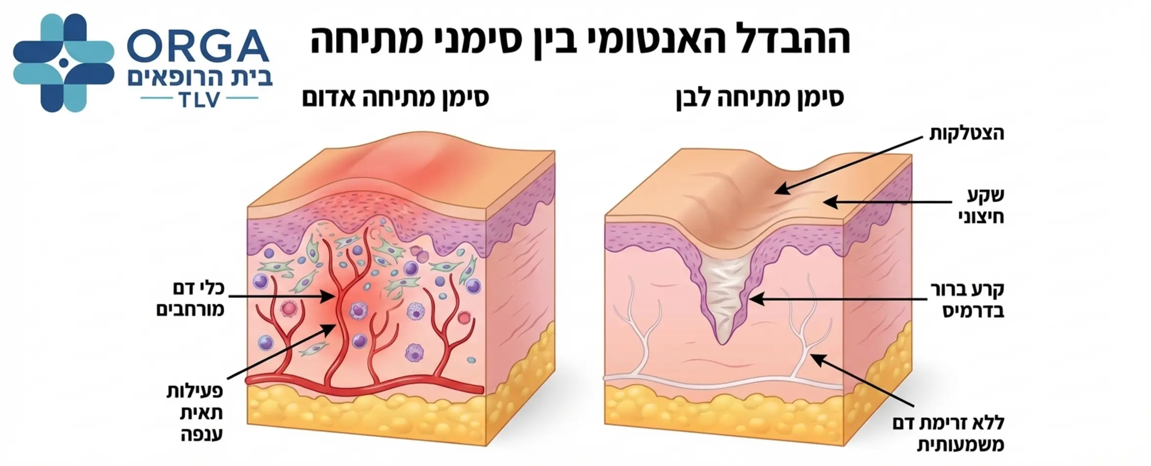אינפוגרפיקה המציגה חתך רוחב של העור וממחישה את ההבדל האנטומי בין סימן מתיחה אדום המכיל כלי דם מורחבים ופעילות תאית ענפה לבין סימן מתיחה לבן שבו קיימת הצטלקות, שקע חיצוני וקרע ברור בשכבת הדרמיס ללא נוכחות של זרימת דם משמעותית