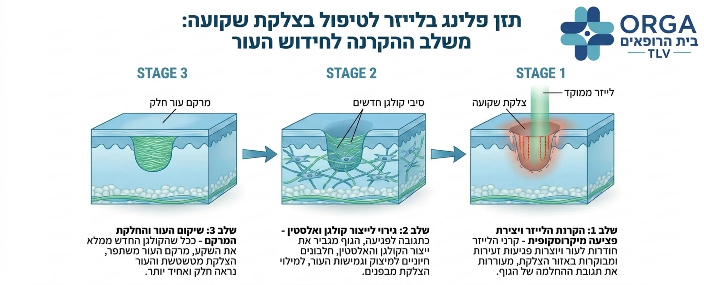 אינפוגרפיקה המחולקת לשלושה שלבים המראה את תהליך הפעולה של פילינג בלייזר על גבי צלקת שקועה, משלב הקרנת הלייזר ועד לייצור קולגן חדש והחלקת מרקם העור