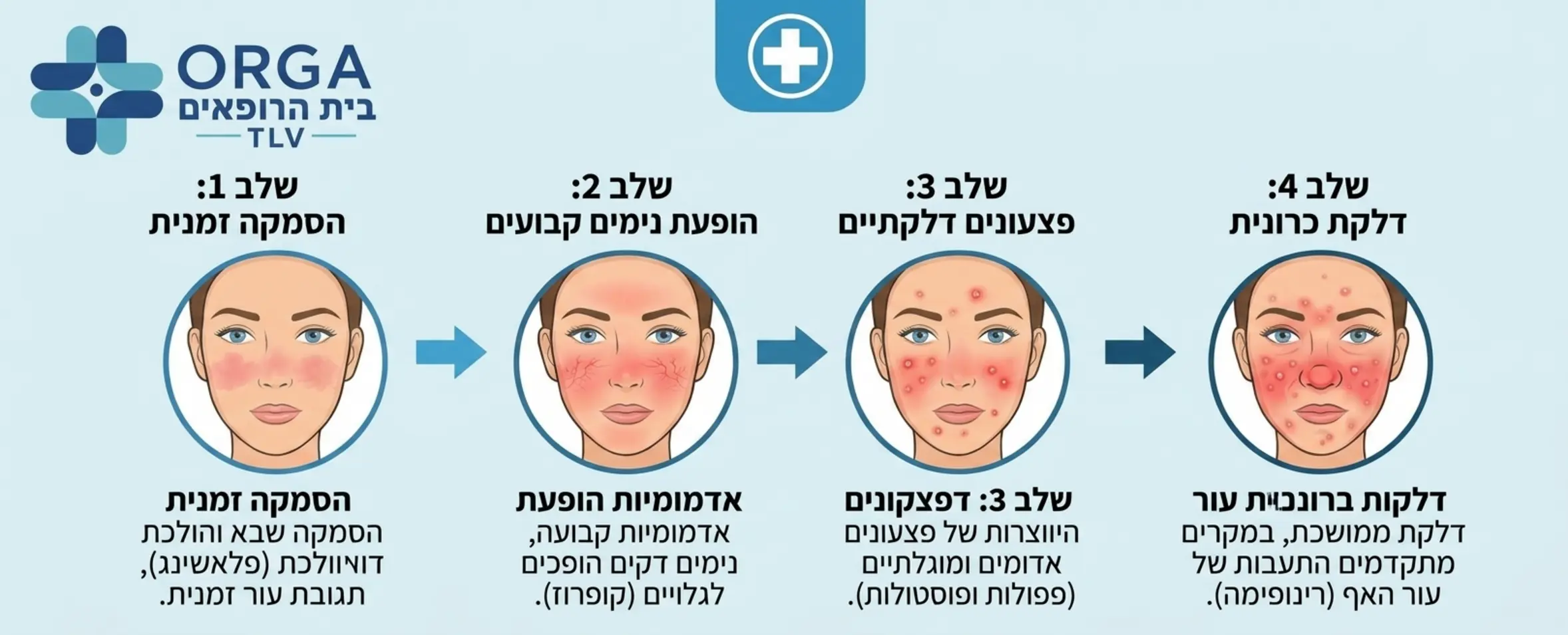 אינפוגרפיקה רפואית המציגה את שלבי ההתפתחות של רוזציאה, החל מהסמקה זמנית, דרך הופעת נימים קבועים ועד להיווצרות פצעונים דלקתיים על פני העור