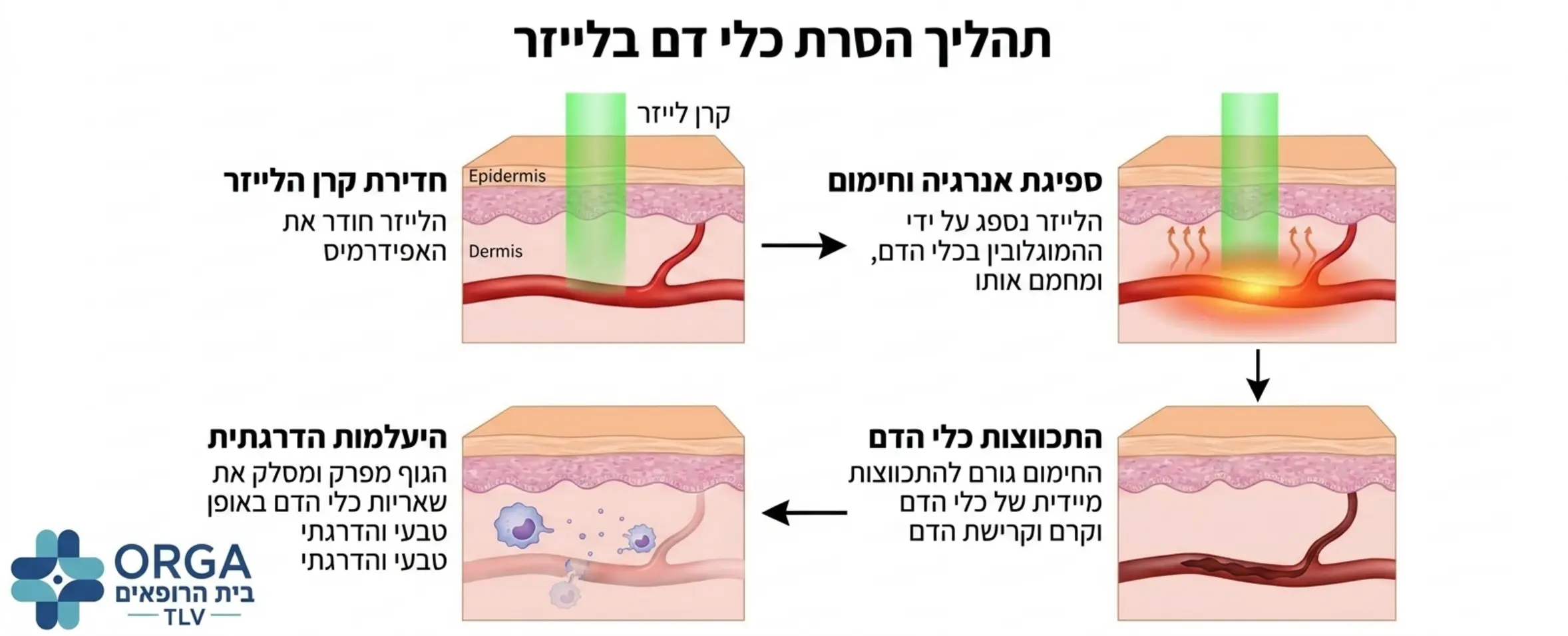 תרשים זרימה חזותי המראה כיצד קרן הלייזר חודרת את שכבת העור העליונה, פוגעת בכלי הדם האדום, מחממת אותו וגורמת להתכווצותו ולהיעלמותו ההדרגתית