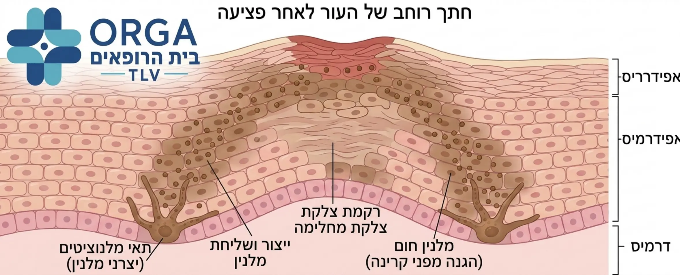אינפוגרפיקה המדגימה חתך רוחב של העור לאחר פציעה, מראה כיצד תאי המלנוציטים בתחתית האפידרמיס מייצרים ושולחים כמויות גדולות של מלנין חום אל אזור הצלקת המחלימה כהגנה מפני קרינה