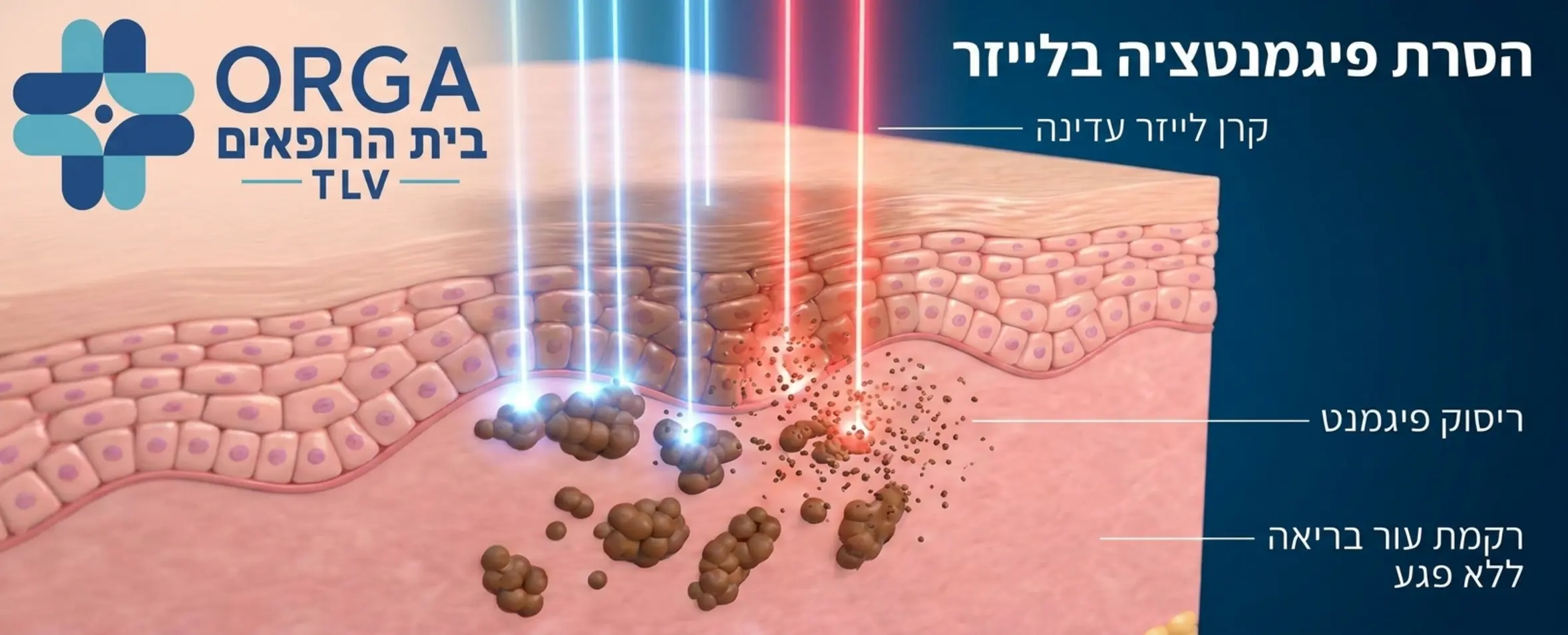 אילוסטרציה תלת מימדית של קרני לייזר עדינות פוגעות במקבצי פיגמנט חום מתחת לעור ומרסקות אותם לחלקיקים זעירים, מבלי לפגוע ברקמת העור הבריאה שסביבם