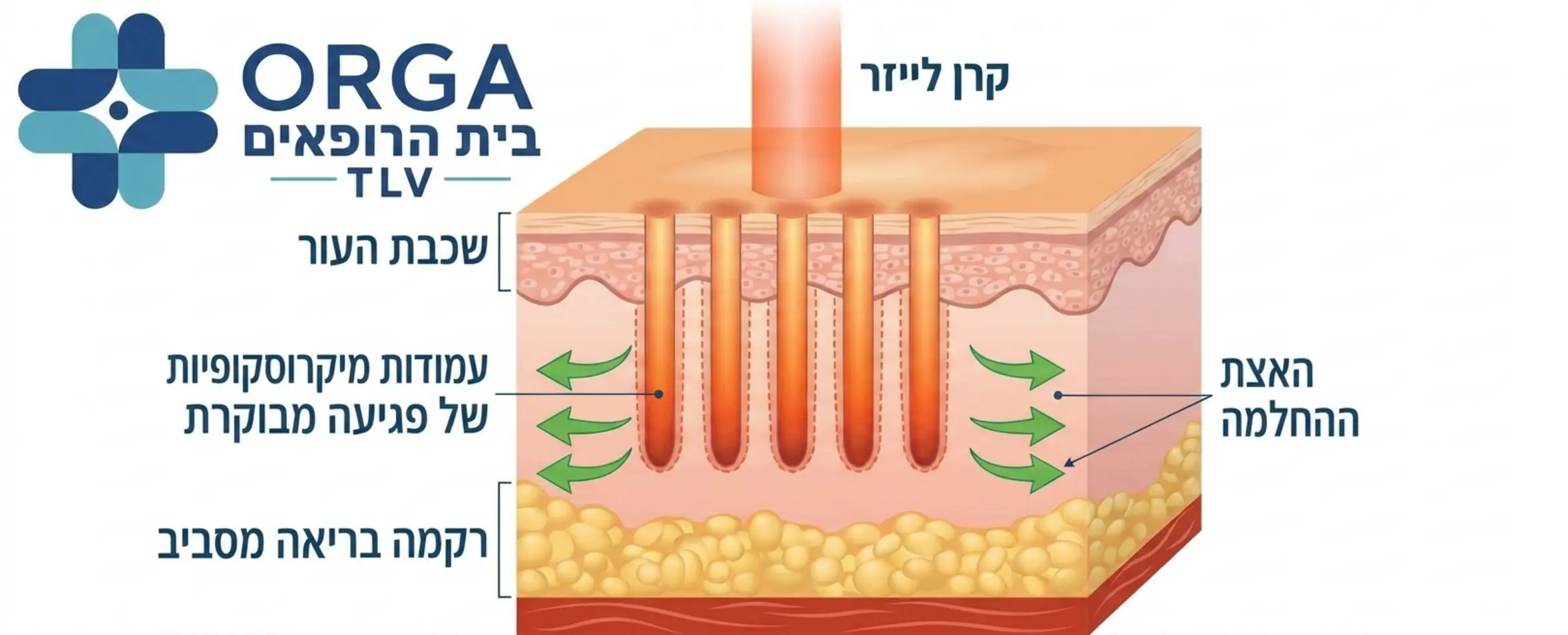 אינפוגרפיקה המדגימה כיצד קרן הלייזר חודרת לעור ויוצרת עמודות מיקרוסקופיות של פגיעה מבוקרת, תוך השארת רקמה בריאה מסביב להאצת ההחלמה