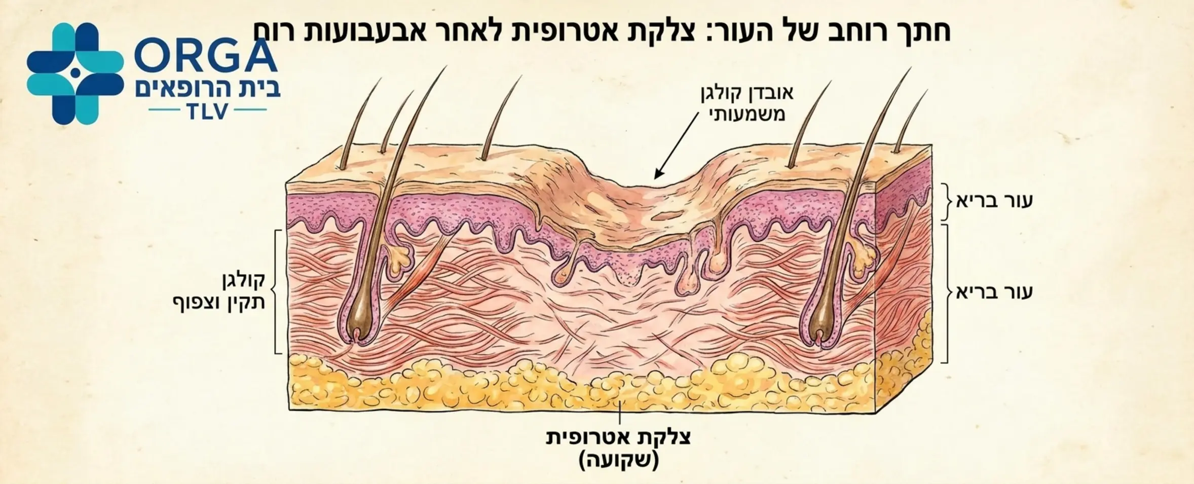 איור רפואי המציג חתך רוחב של העור עם צלקת אטרופית שקועה הנוצרת לאחר מחלת אבעבועות רוח, המדגים בבירור את אובדן הקולגן בשכבת הדרמיס לעומת העור הבריא שמסביב