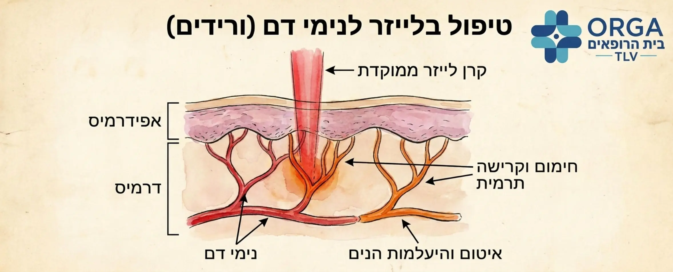 איור רפואי המדגים כיצד קרן הלייזר חודרת את העור מתמקדת בנים הדם מחממת אותו וגורמת לו להיאטם ולהיעלם