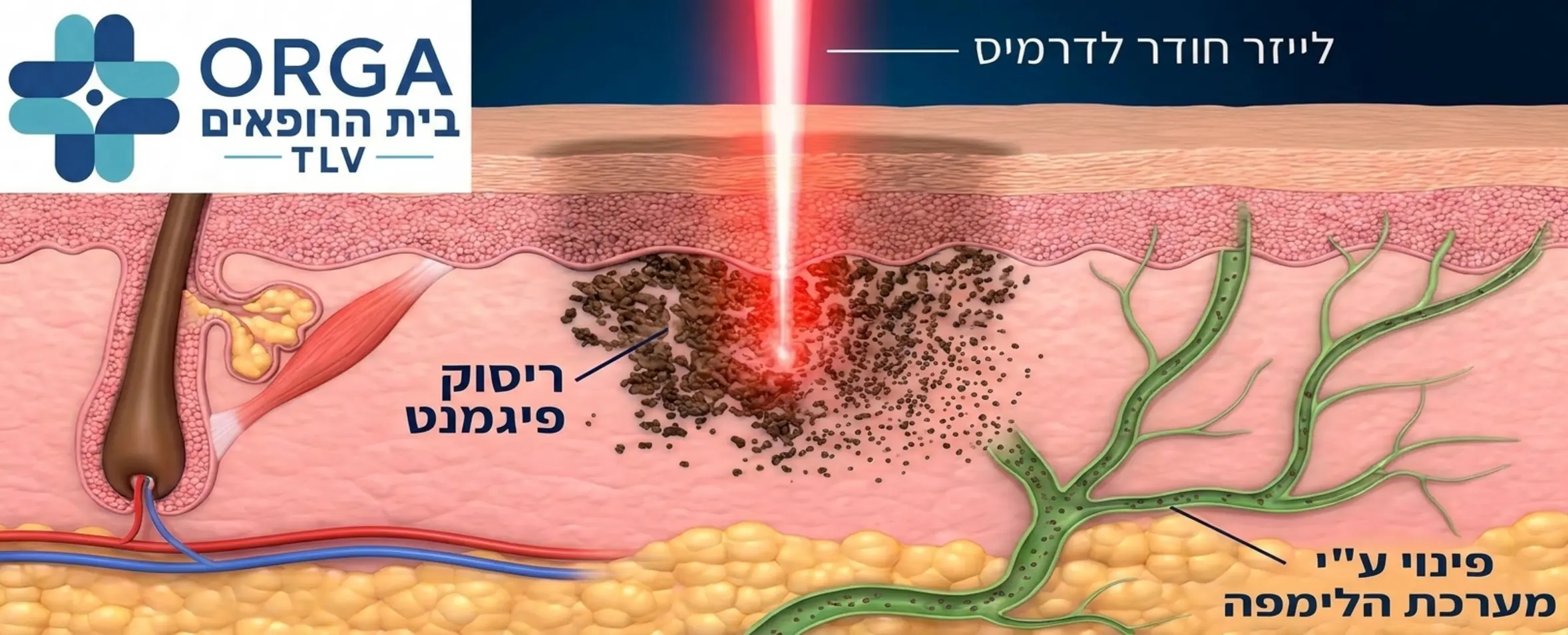 איור תלת ממדי רפואי המדגים כיצד קרן הלייזר חודרת לשכבת הדרמיס ומרסקת את הצטברות הפיגמנט העודף לחלקיקים זעירים שהגוף מפנה באופן טבעי באמצעות מערכת הלימפה