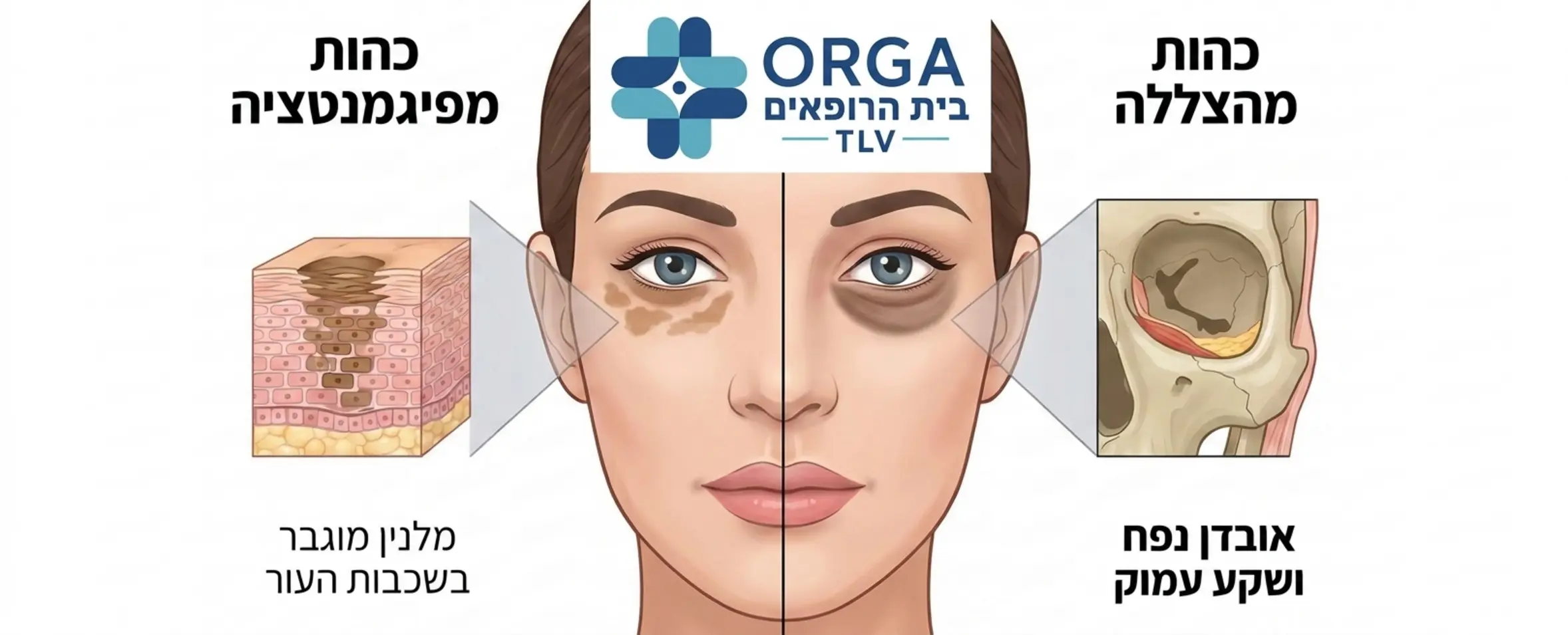 אינפוגרפיקה המציגה פנים של אישה חצויות לשניים, צד אחד מדגים כהות מתחת לעין הנובעת מפיגמנטציה חומה בשכבות העור, והצד השני מדגים כהות הנובעת מהצללה של שקע עמוק וחוסר נפח תחת העין.