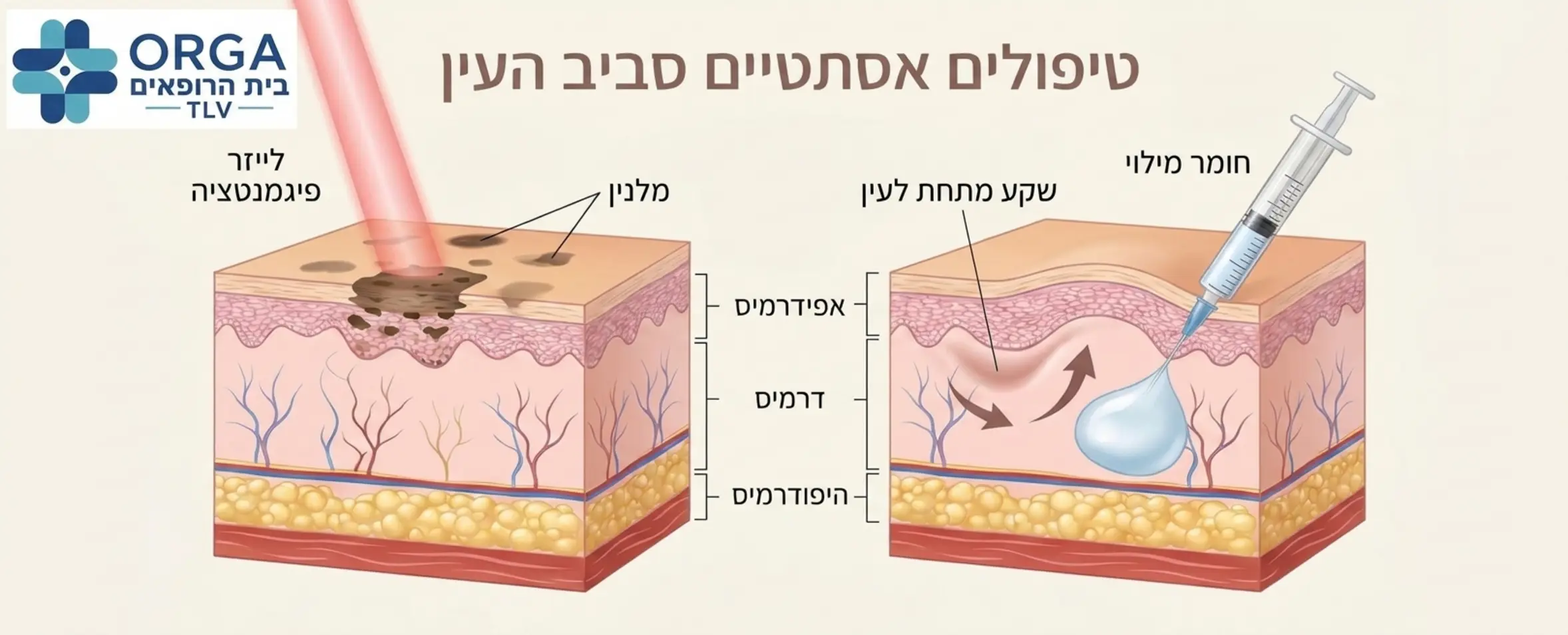 תרשים רפואי אסתטי המדגים את שכבות העור סביב העין, עם חצים המראים כיצד קרן לייזר פוגעת במלנין בשכבה העליונה, ולעומת זאת כיצד הזרקת חומר מילוי מרימה את העור מבפנים באזור השקע.