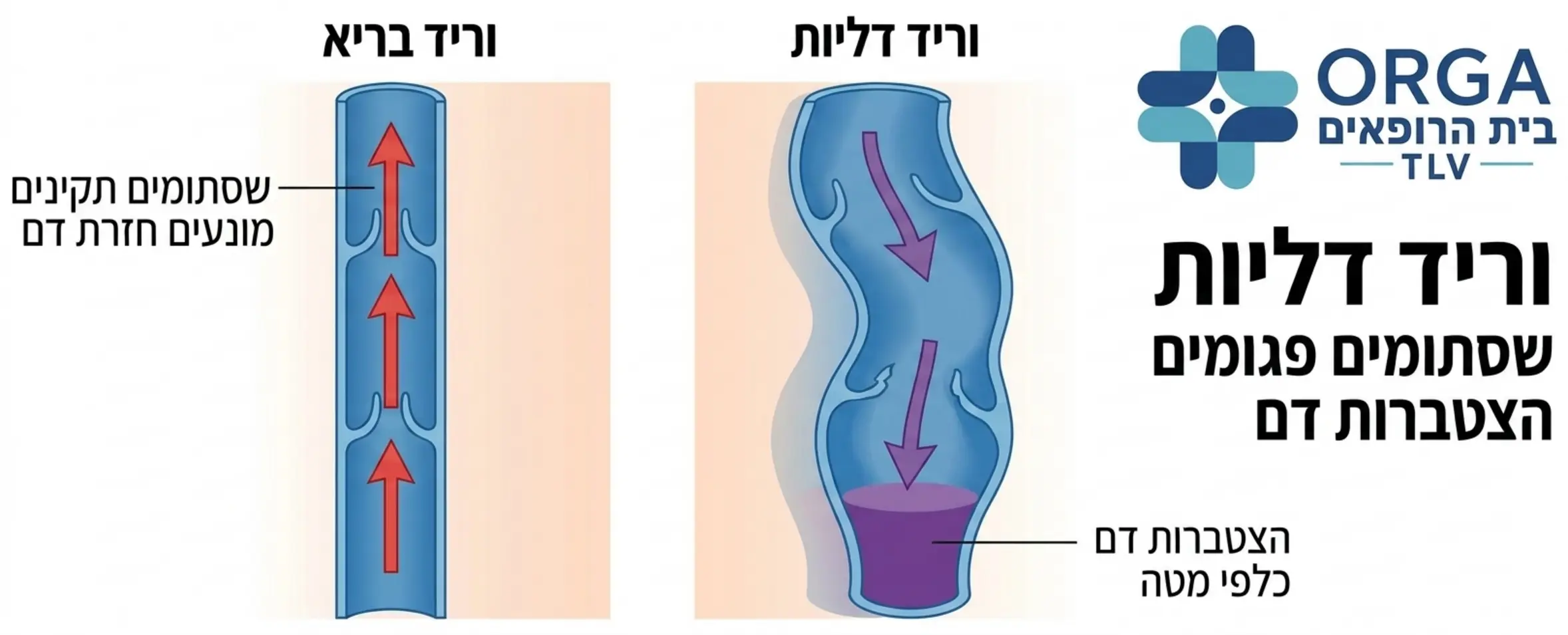 אינפוגרפיקה רפואית המציגה את ההבדל בין וריד בריא עם שסתומים תקינים לבין וריד דליות עם שסתומים פגומים הגורמים להצטברות דם כלפי מטה