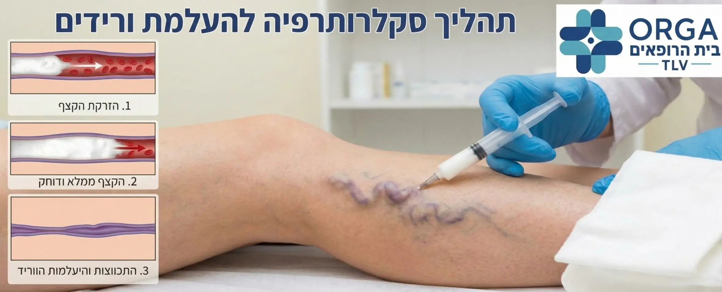 המחשה ויזואלית של תהליך סקלרותרפיה בו רופא מזריק קצף מיוחד לתוך וריד בולט וסגלגל ברגל, ומראה כיצד הקצף ממלא את הווריד, דוחק את הדם וגורם לו להתכווץ בהדרגה