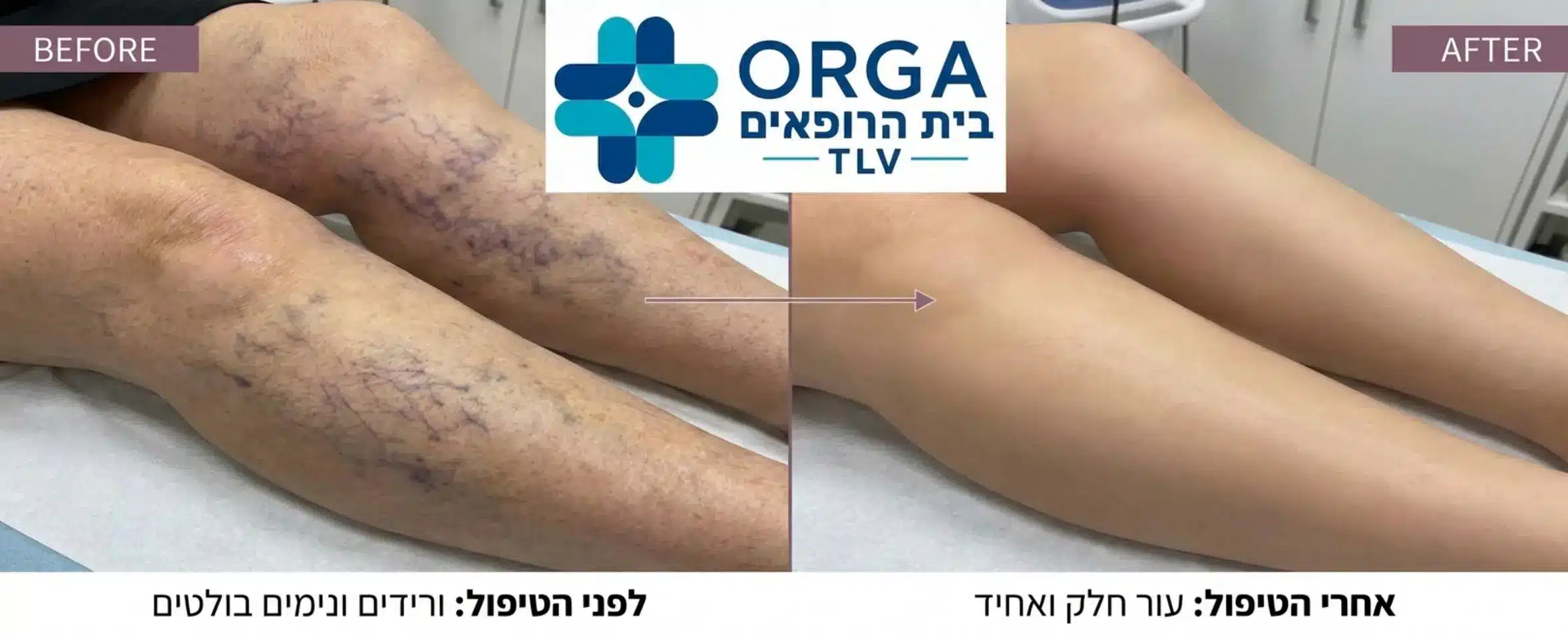 צילום תקריב איכותי של רגליים לפני ואחרי טיפול משולב, המראה בחלק אחד של התמונה ורידים בולטים ורשת נימים סגולה, ובחלק השני היעלמות מוחלטת שלהם המותירה עור חלק, אחיד ונקי מפגמים