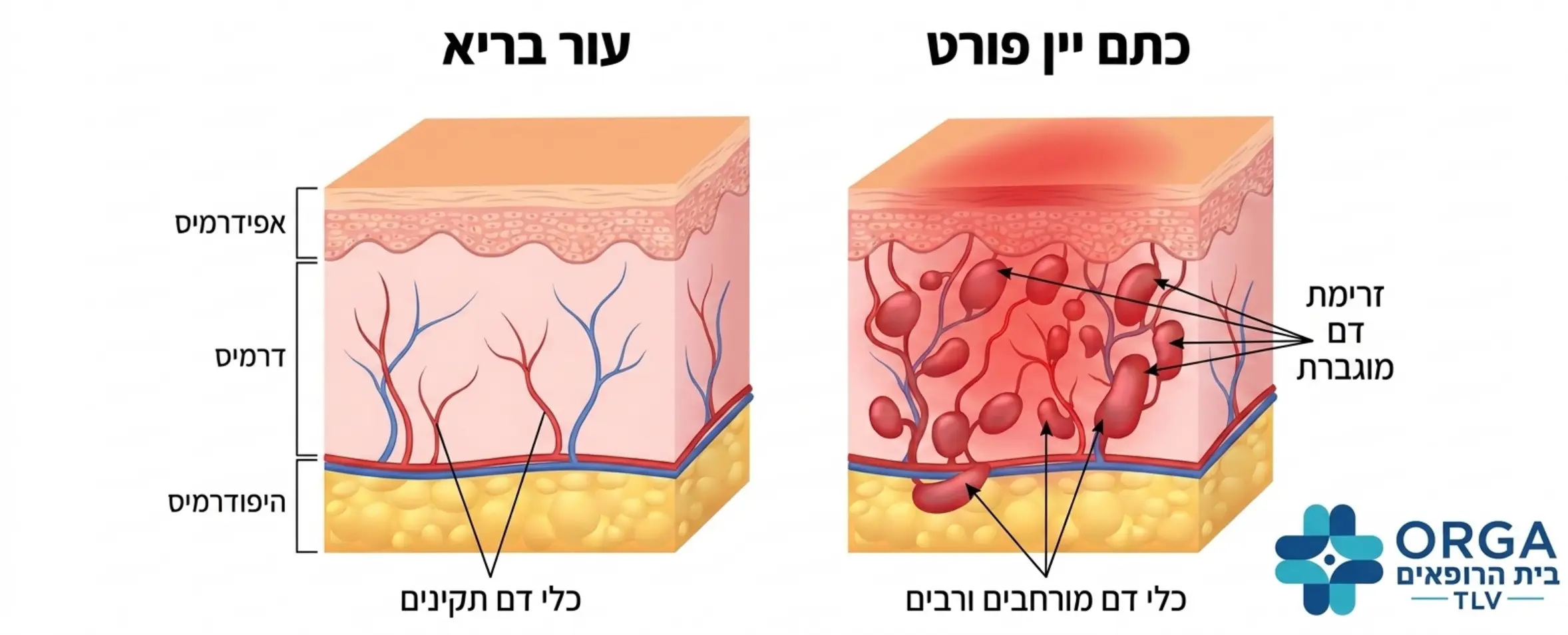 אינפוגרפיקה רפואית המציגה את שכבות העור ואת ריבוי כלי הדם המורחבים באזור כתם יין פורט לעומת עור בריא