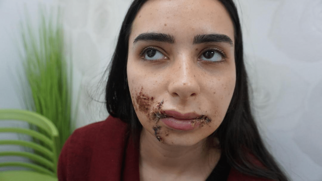 פציעה בפנים עם תפרים אחרי תאונת דרכים — תחילת הטיפול