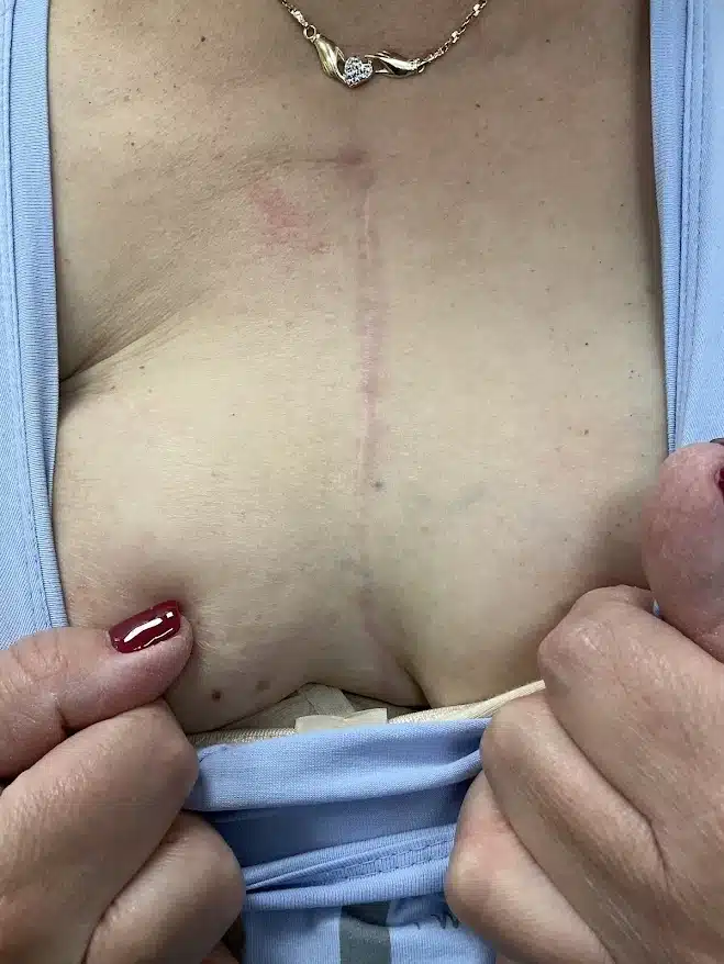 צלקת החזה אחרי סדרת טיפולים — שטוחה, בהירה וללא כאב