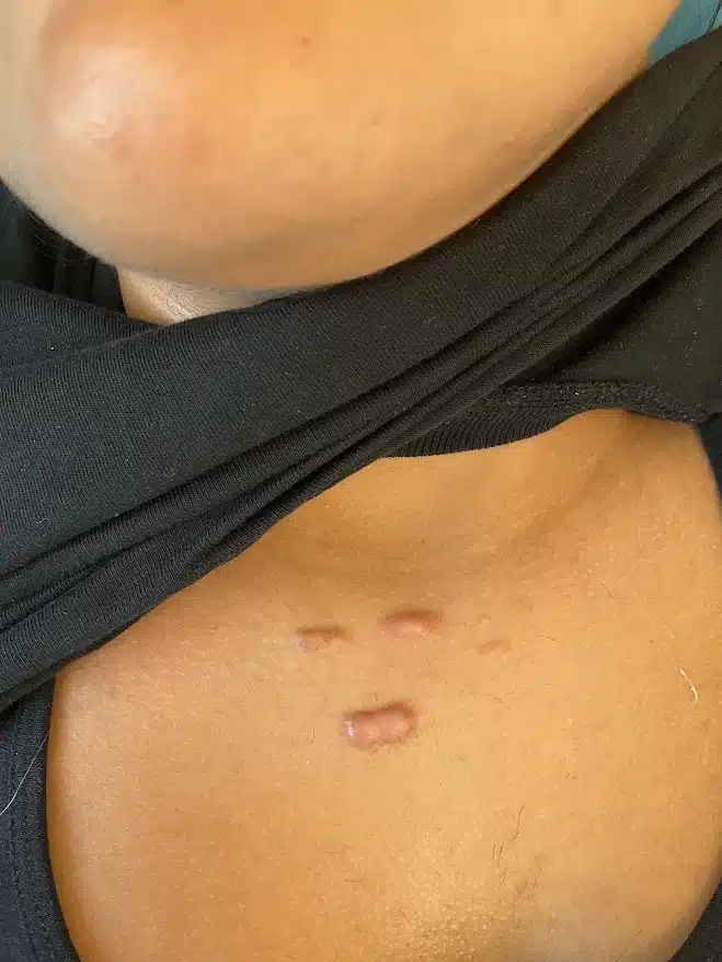 צלקת קלואידית בחזה לפני טיפול — רקמה מורמת ובולטת