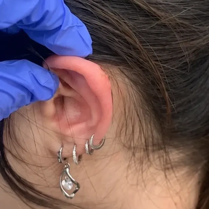 אותה אוזן אחרי סדרת טיפולים — שולי האוזן חלקים